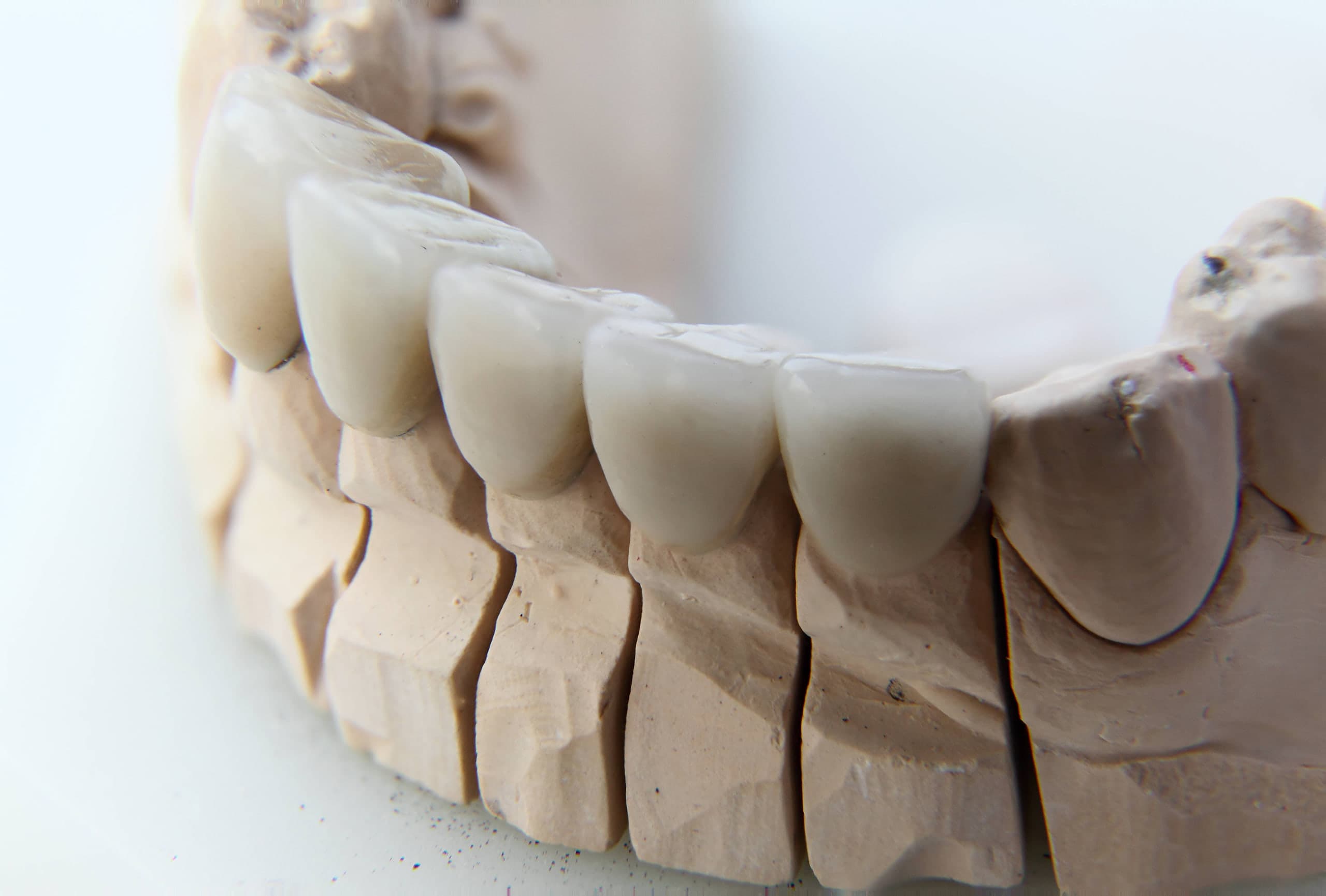 Ön bölge kron dizisi — Metal-porselen | Boyut Dental